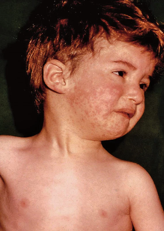 Spalničky u neočkovaného dítěte (archiv Infekční oddělení Nemocnice Na Bulovce)