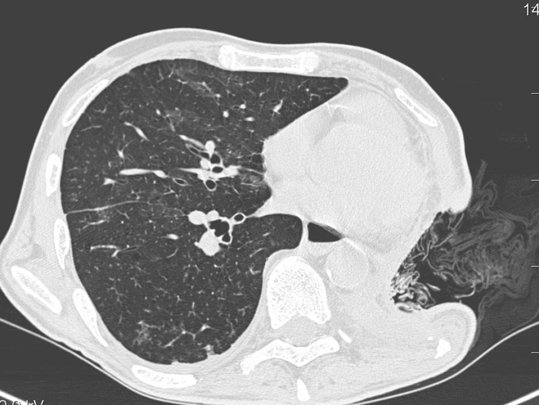 CT-Vytvořené pleurostoma pro postpneumonektomický empyém, roušky s dezinfekcí in situ
Fig. 1. CT scan of the open pleural window created for empyema post pneumonectomy, packing in situ