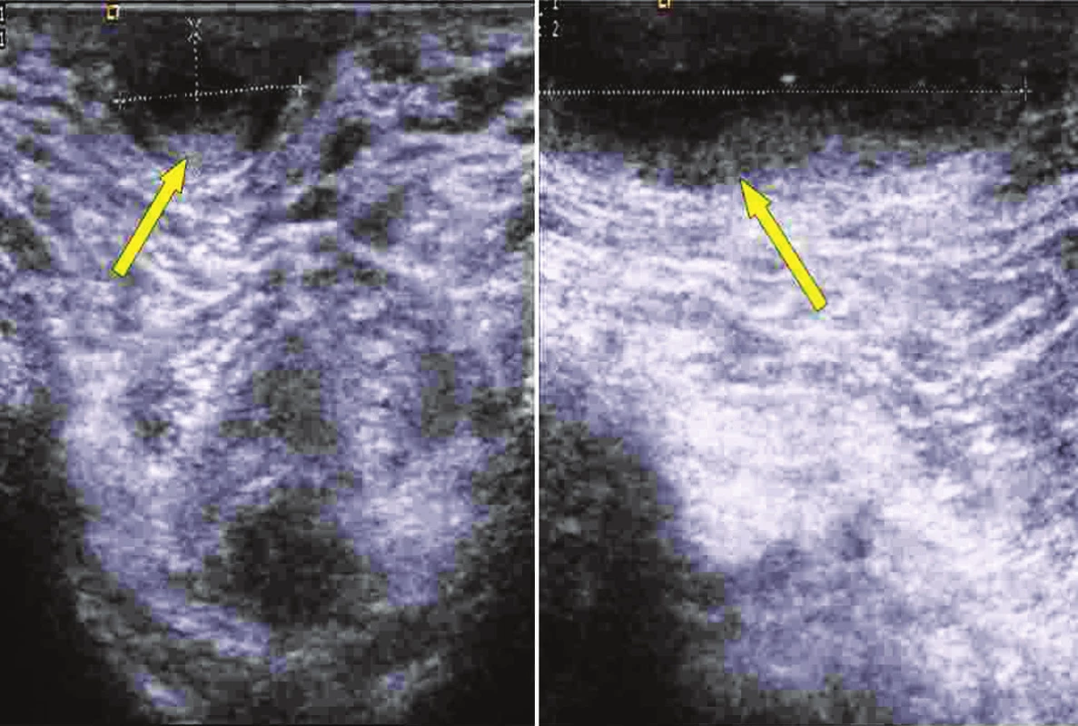 USG perianální krajiny s anální píštělí
Fig. 3. Ultrasound examintion of perianal region with anal fistula