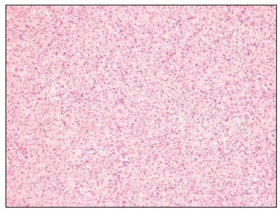 Velmi buněčný maligní SFT je tvořen fascikulárně a storiformně utvářenými vřetenitými buňkami s poměrně dužnatými protáhlými jádry (H.E., zv. 100x).
