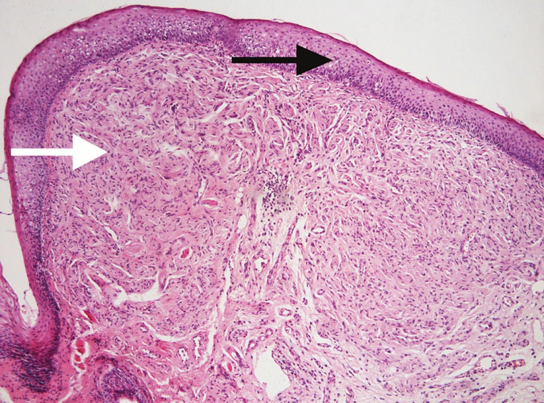 Těsně pod vrstevnatým dlaždicobuněčným epitelem zastižen dobře ohraničený vřetenobuněčný nádor tvořený buňkami s protáhlými jádry, odpovídající neurofibromu. Černou šipkou označen vrstevnatý dlaždicobuněčný epitel, bílou šipkou struktury neurofibromu (barvení H&amp;E, zvětšeno 10krát).