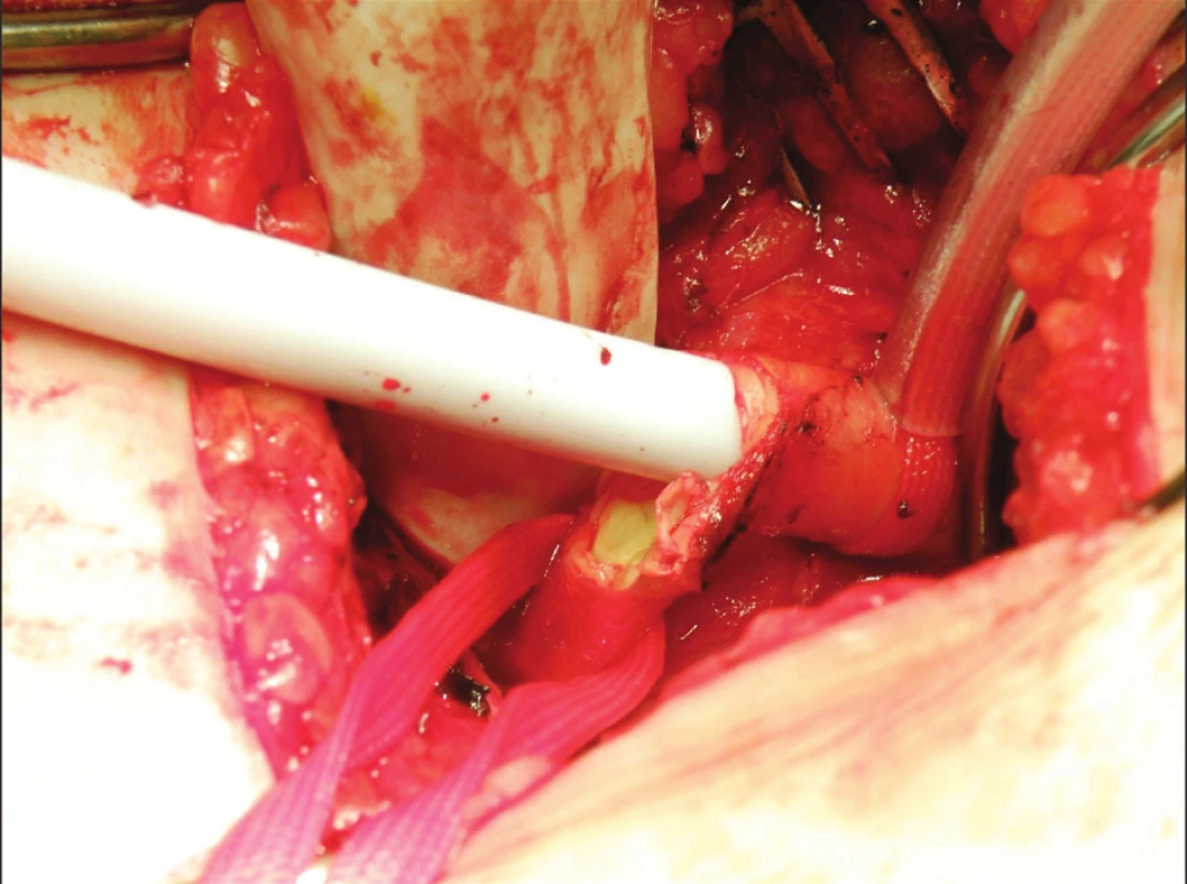 Lacerace stehenní tepny
Fig. 2. Femoral artery laceration