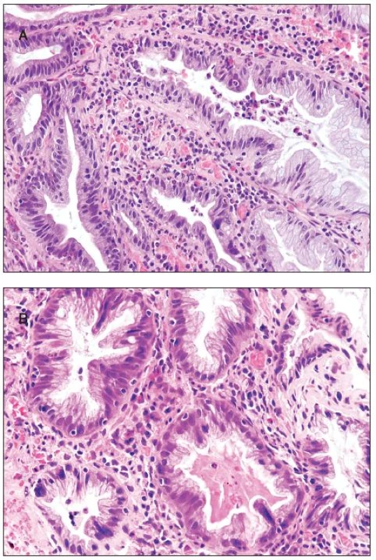Hyperplastic polyp. A - cryptitis and inflammatory infiltrate with numerous eosinophils; B - multinucleated giant cells are seen in some crypts.