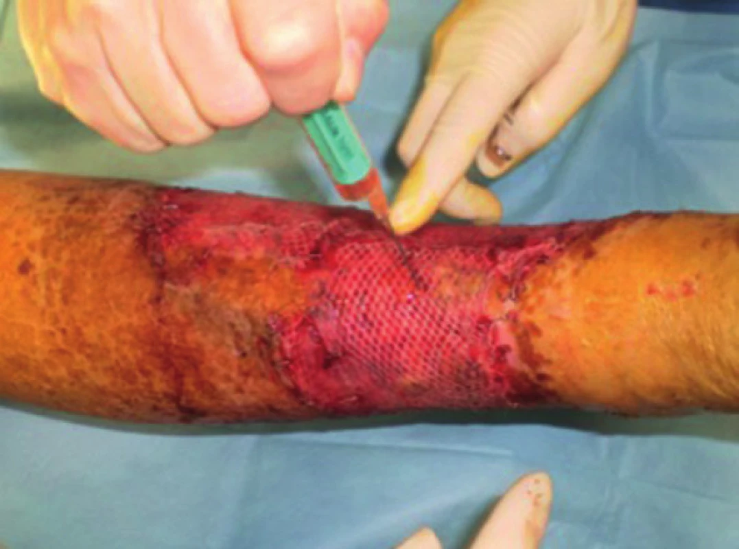 Pacient č. 3 − dermoepidermální autotransplantace s použitím autologní PRP
Fig. 2: Patient No. 3 − split-thickness skin graft and autologous PRP