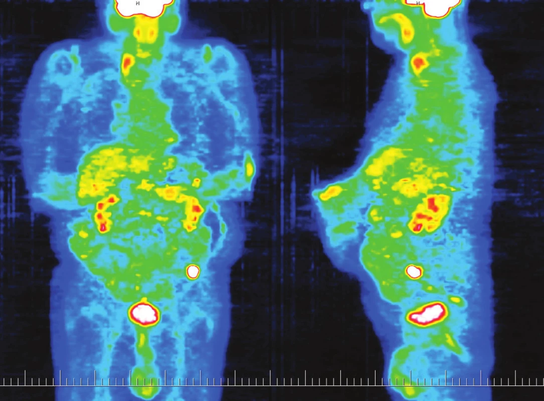 PET zobrazující ložisko viabilní nádorové tkáně v levém hypogastriu
Fig. 3. PET depicting a focus of viable tumor tissue in the left hypogastrium