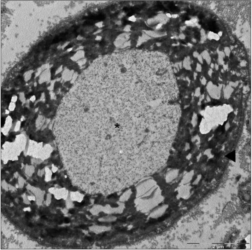 Mikrofotografie – částečný rozpad myelinové pochvy (►), axon (*) bez histopatologických změn (elektronová mikroskopie, n. suralis).