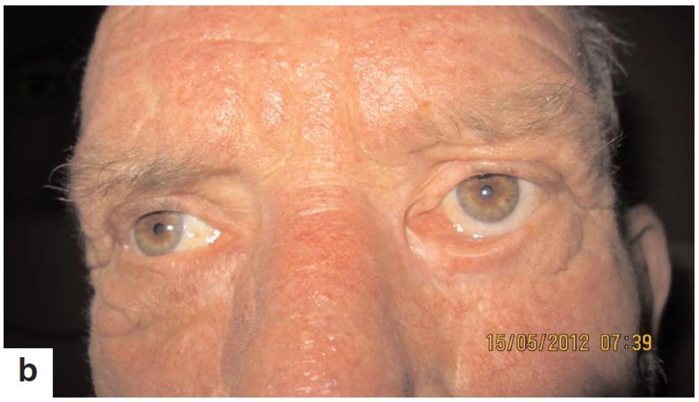 Pacient s recidivujúcim bazaliómom mediálneho kútika ľavého oka pred liečbou – november 2010 po liečbe je bez recidívy, pretrvávajúce ektropium – máj 2012