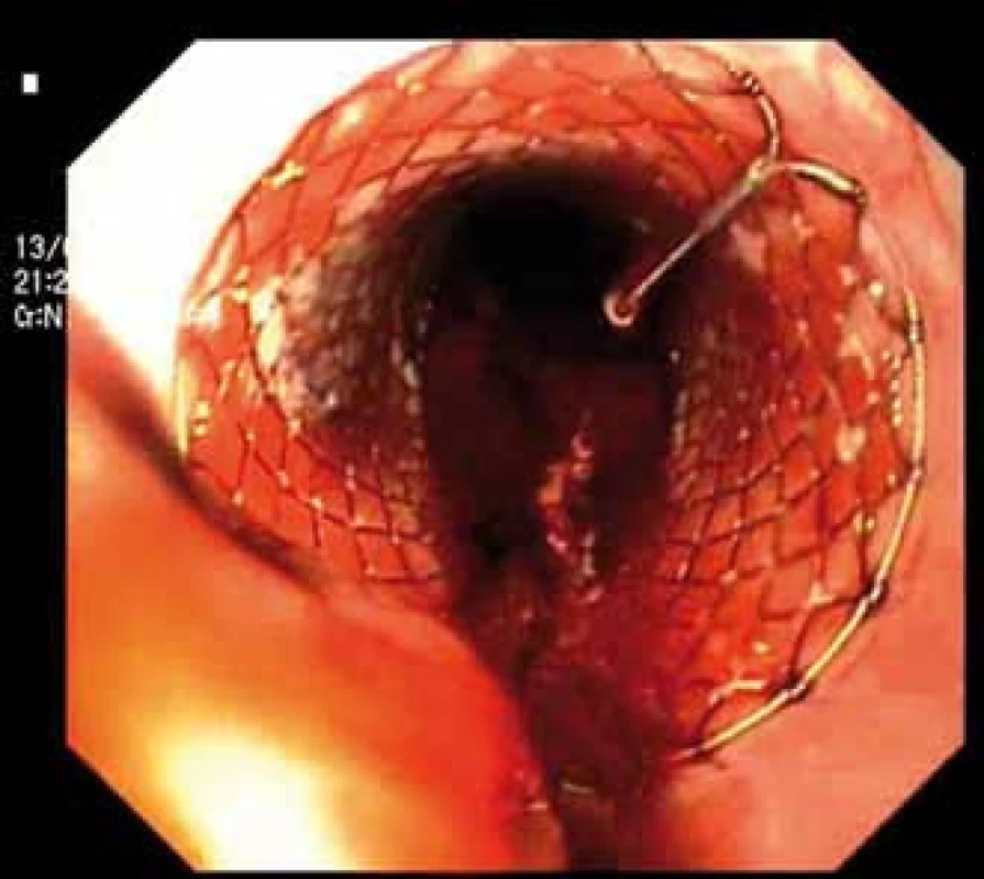Zavedení Danišova stentu – endoskopický pohled.
Fig. 1. Application of Danis stent – endoscopic image.