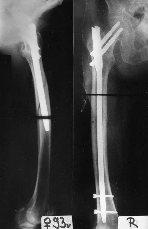 Vliv zakřivení femuru na zavádění hřebu: a – pertrochanterická zlomenina, patrný široký dřeňový kanál, ale výrazněji zakřivený; b – rtg v ap projekci po osteosyntéze hřebem o průměru 13 mm; c – pooperační rtg v axiální projekci ukazuje kolizi mezi hřebem a tvarem dřeňového kanálu, jehož výsledkem byla zlomenina diafýzy femuru; d – provedena reoperace, delším, tenčím, anatomicky tvarovaným hřebem
Fig. 14: Effect of femur curvature on insertion of the nail: a – pertrochanteric fracture, a wide medullary canal with a more marked curvature; b – radiograph in ap view after internal fixation by a nail with 13mm diameter; c – postoperative radiograph in axial view shows mismatch between the nail and the shape of the medullary canal, which resulted in fracture of the femoral shaft; d – reoperation performed with a longer, thinner, anatomically shaped nail.
