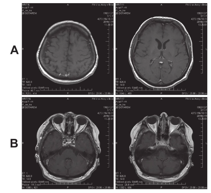 MR dokumentovaný stav po farmakologické léčbě mozkové toxoplazmózy s vymizením hypersignálních ložisek supratentoriálně (A) i infratentoriálně (B) na T1WI po podání kontrastní látky.