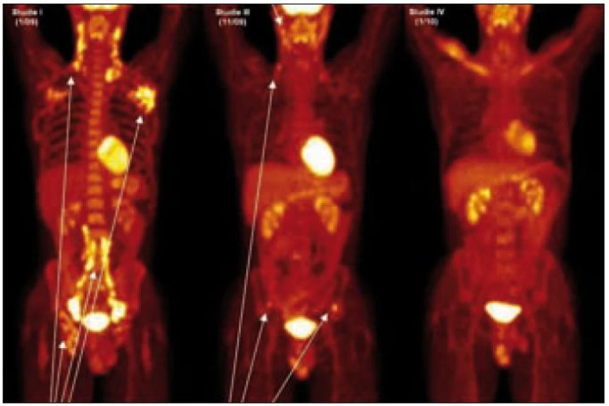 PET-CT u muže narozeného 1973 s průběhem nemoci podobným lymfomu a s plicním postižením. Na prvním obrázku vlevo vyšetření před léčbou, je velmi dobře zřetelná patologicky zvýšená aktivita v oblasti krčních, axilárních, ilických a tříselných uzlin, ale nebylo zřetelné poškození kostí. Na prostředním obrázku, který byl proveden v době relapsu dva měsíce po ukončení léčby 2-chlorodeoxyadenosinem, je zřetelná patologicky zvýšená aktivita v oblasti krčních uzlin a dále v oblasti lopat kosti kyčelní, kde na low dose CT byla prokázána osteolytická ložiska. Na obrázku vpravo je vyhodnocení účinnosti léčby po dvou cyklech CHOEP a zde není zřetelná žádná patologická akumulace flurodeoxyglukózy.
