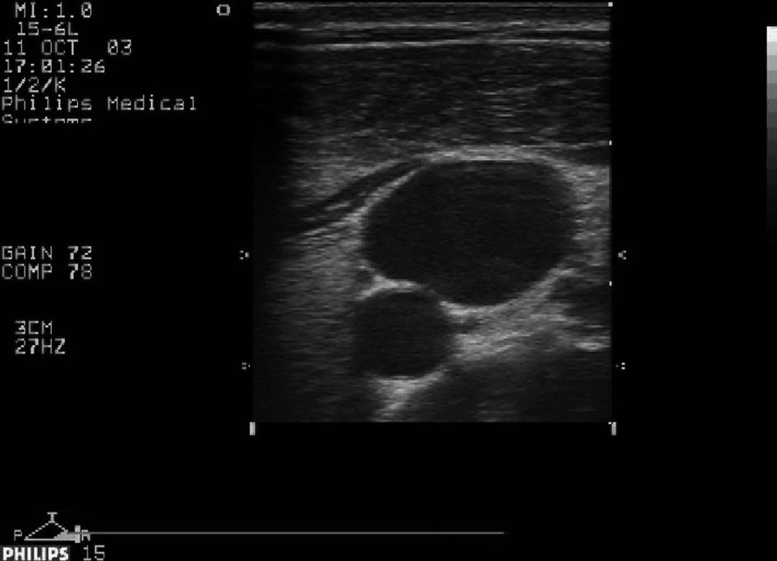 Levá vnitřní jugulární žíla přibližně na úrovni vrcholu větvení sternálního a klavikulárního úponu m.sterno cleidomastoideus, okrouhlé lumen pod ní a mediálně (z pohledu pacienta) je levá společná karotida.