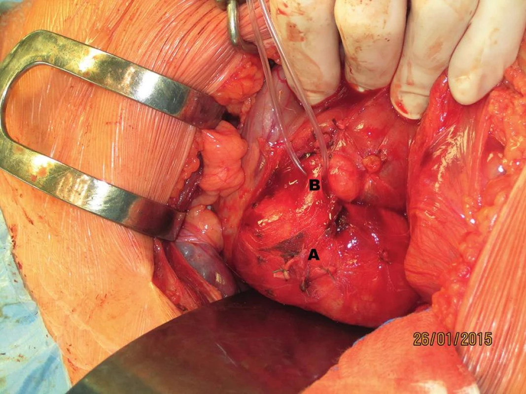Laparotomie, transrektální řez v pravém podžebří (A – cysta ductus choledochus, B – distální choledochus)
Fig. 4: Laparotomy, transrectal incision in the right upper quadrant (A – choledochal cyst, B – distal bile duct)