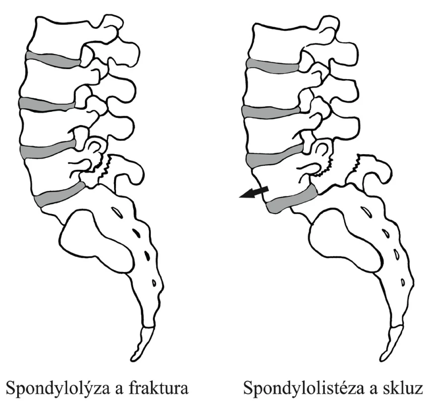 Spondylolýza a spondylolistéza