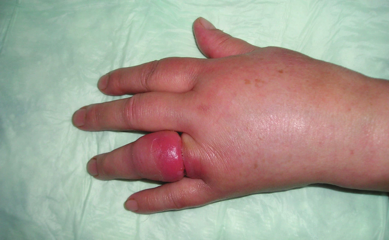 Pohľad na prst ihneď po odstránení prsteňa
Fig. 1. View of the finger immediately following removal of
the ring