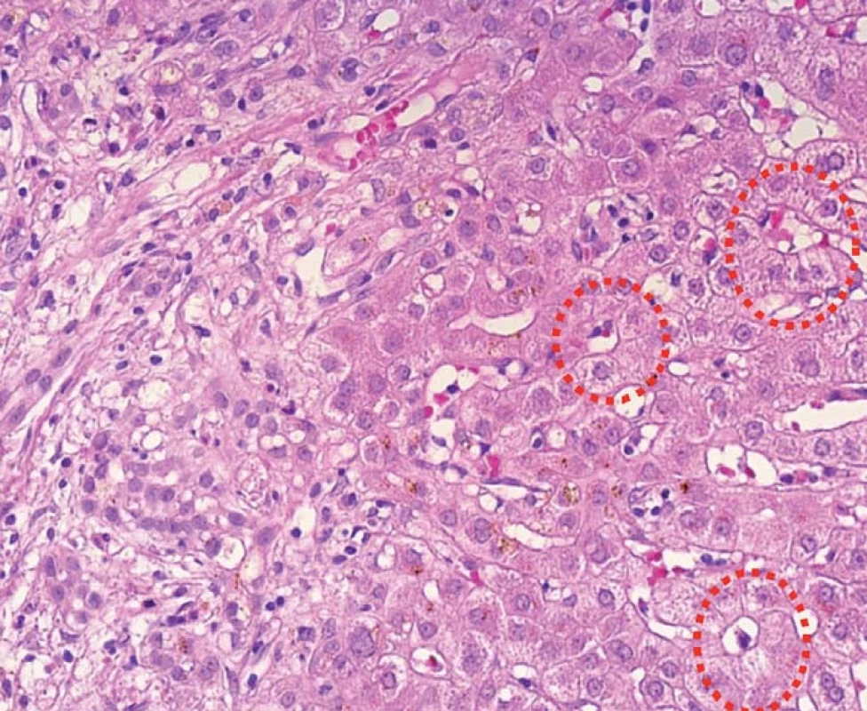 Typická morfologie poruchy žlučové drenáže s edémem portálního pole (vlevo) a fokální přestavbou do tzv. cholestatických rozet (červeně).