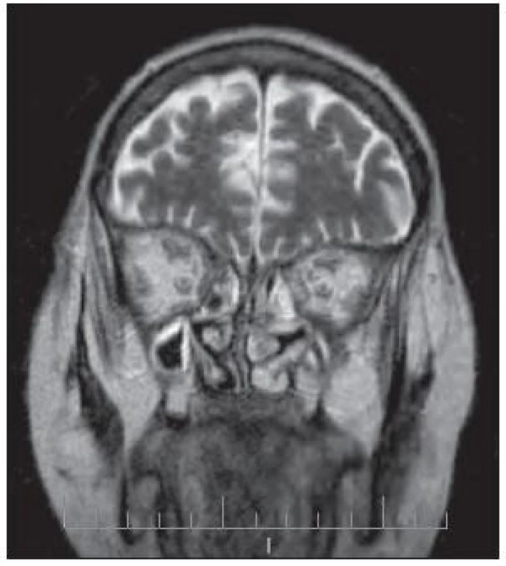 Invazivní mykóza PND s propagací do očnice – MR v koronární projekci.
Zastínění etmoidů, infiltrace okohybných svalů a retrobulbárního prostoru se známkami neuritidy optiku oboustranně.