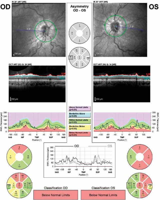 Pacientka s oboustrannou parciální atrofií papily zrakového nervu po proběhlé idiopatické intrakraniální hypertenzi zastižené na optické koherentní tomografii. Tato atrofie je obtížně prokazatelná při oftalmoskopickém vyšetření, ale identifikovatelná právě při vyšetření tloušťky vrstvy nervových vláken sítnice na OCT. Shora na obrázku jsou zobrazeny terče zrakového nervu na sítnici. Zelená kružnice cirkulárně kolem nich označuje místo měření tloušťky vrstvy nervových vláken sítnice. Další obrázky shora zastihují průřez sítnicí v oblasti měření vrstvy nervových vláken. Pod průřezovými obrázky jsou grafy znázorňující tloušťku vrstvy nervových vláken sítnice na ose y a na ose x jsou vyjádřena měření v bodech kolem papily cirkulárně v úhlových stupních. Zásadní jsou kruhové diagramy dole, které zobrazují analogicky k obrázkům 2 a 3 (viz výše) jednotlivé kvadranty s číselnými hodnotami tloušťky vrstvy nervových vláken sítnice. Žlutá barva v jednotlivých sektorech znamená hraničně snížené hodnoty, červená barva signalizuje nízké hodnoty tloušťky vrstvy nervových vláken sítnice, resp. atrofii těchto vrstev.