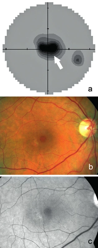 Statická automatická perimetrie pravého oka a) s centrálním výpadem zorného pole (označen šipkou) z pohledu pacienta. Fotografie očního pozadí pravého oka z pohledu lékaře dokumentuje b) prstenec zašednutí okolo normální fovey, temporálně přítomno ložisko depigmentace, c) stejný nález na bezčerveném snímku