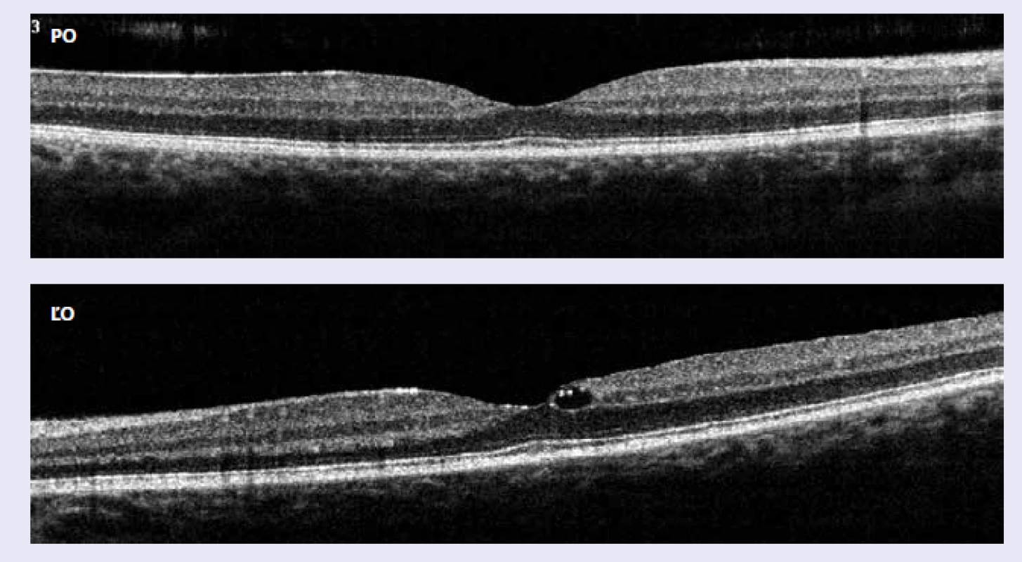 Optická koherentná tomografická angiografia: pravé oko (PO) – makula má normálnu stratifikáciu s fyziologickou foveálnou depresiou, ľavé oko (ĽO) makula s mierne oploštenou foveálnou depresiou a počínajúcim fokálnym diabetickým edémom makuly