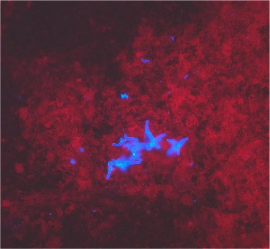 Fluorescence microscopy of bronchoalveolar lavage sample; Fungiqual A, 400-fold magnification