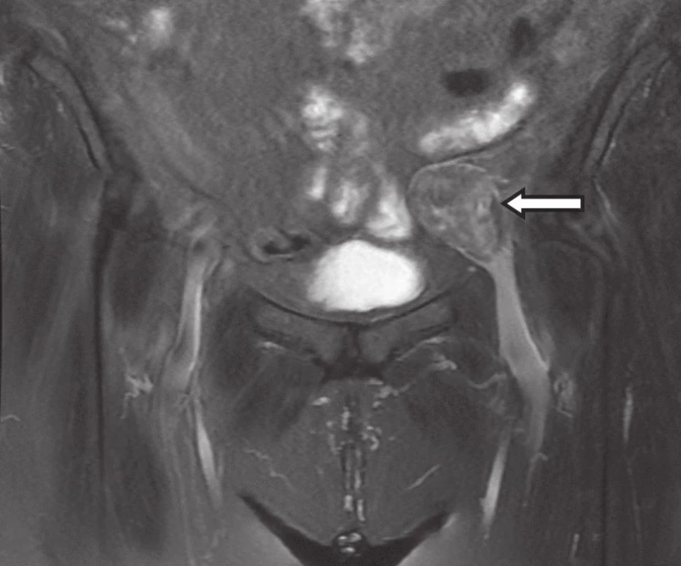 MRI − tumor vonkajšej panvovej žily
Fig. 1: MRI − tumor of external iliac vein