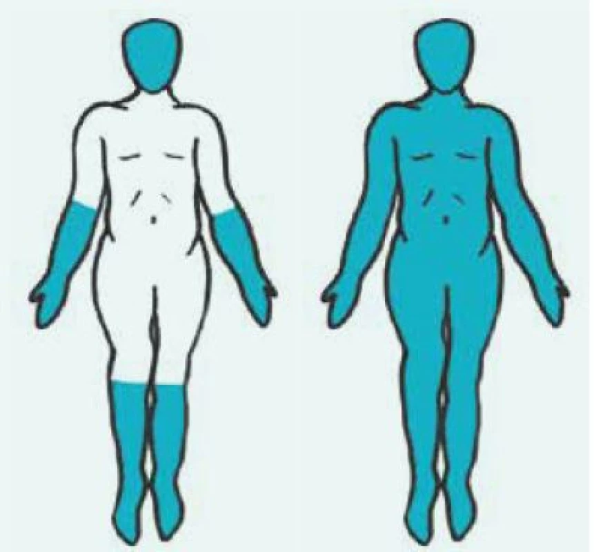 Rozlišení kožně limitované formy systémové sklerodermie (vlevo) od kožně difuzní formy (vpravo) podle rozsahu postižení kůže. Postižené části kůže jsou vyobrazeny barevně