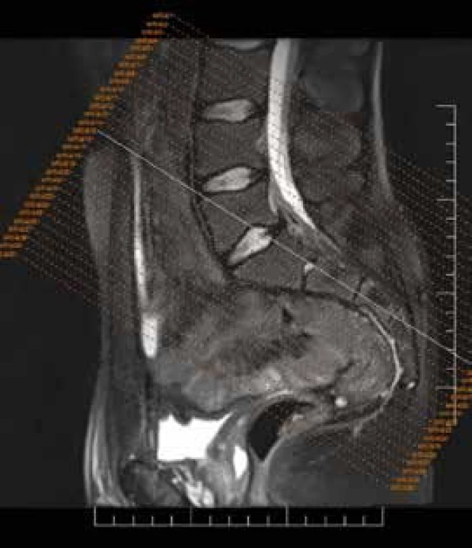 MRI sakroiliakálnych kĺbov – semikoronárne rezy paralelne orientované s pozdĺžnou hranou os sacrum. Archív autora