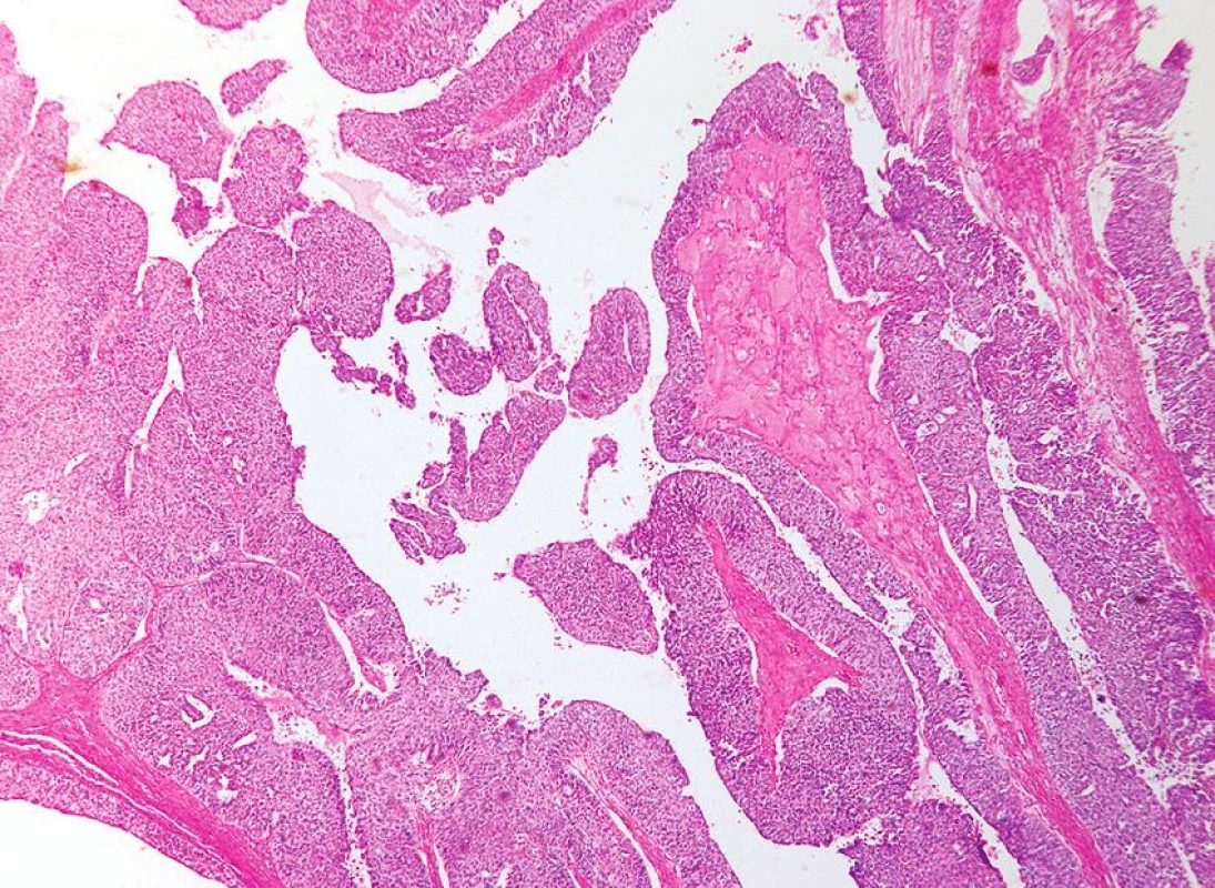 Karcinom z přechodních buněk papilární a cystické úpravy (HE, 40krát)
