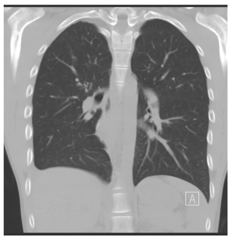 CT plic nativní, koronální rekonstrukce v plicním
okně po operaci: zobrazující plíce zcela rozvinuté bez patologického
rozšíření cévních struktur, bez známek přetrvávajících
viditelných AV píštělí či abnormalit v cévním
řečišti zbylého plicního parenchymu<br>
Fig. 4: Native CT scan of the lungs, coronal reconstruction
in the pulmonary window after surgery: lungs completely
expanded without any pathological dilation of the vascular
structures, without any signs of persistent visible
AV fistulas or abnormalities of the remaining pulmonary
parenchyma