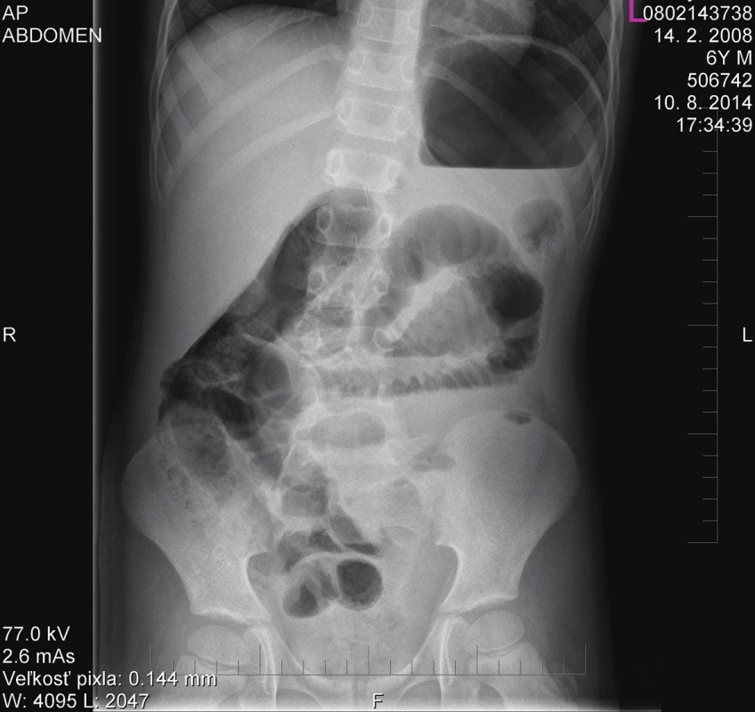 Abdominal RTG: confirmed ileus with typical signs of the obstruction of the intestinal passage.