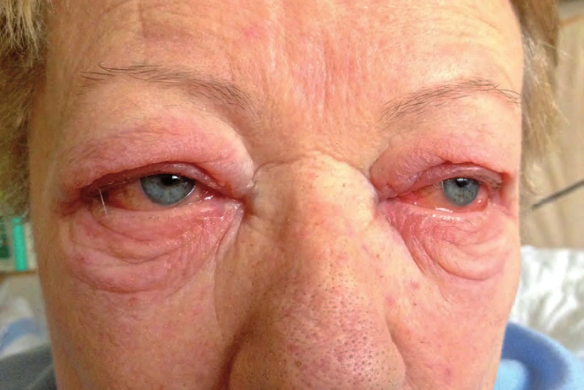 Oční postižení při léčbě ipilimumabem.