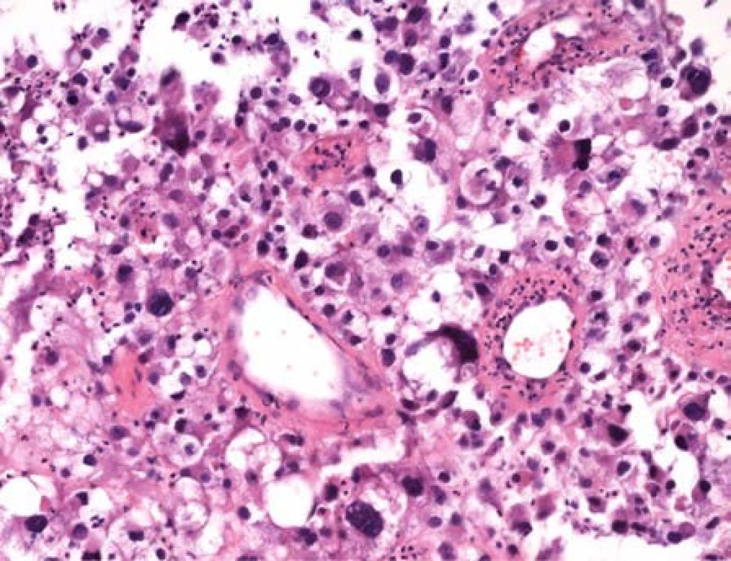 Histologický preparát s nálezem atypických pleomorfních buněk s velkými jádry
Fig. 2. Histological specimen of pleomorphic cells with giant nuclei