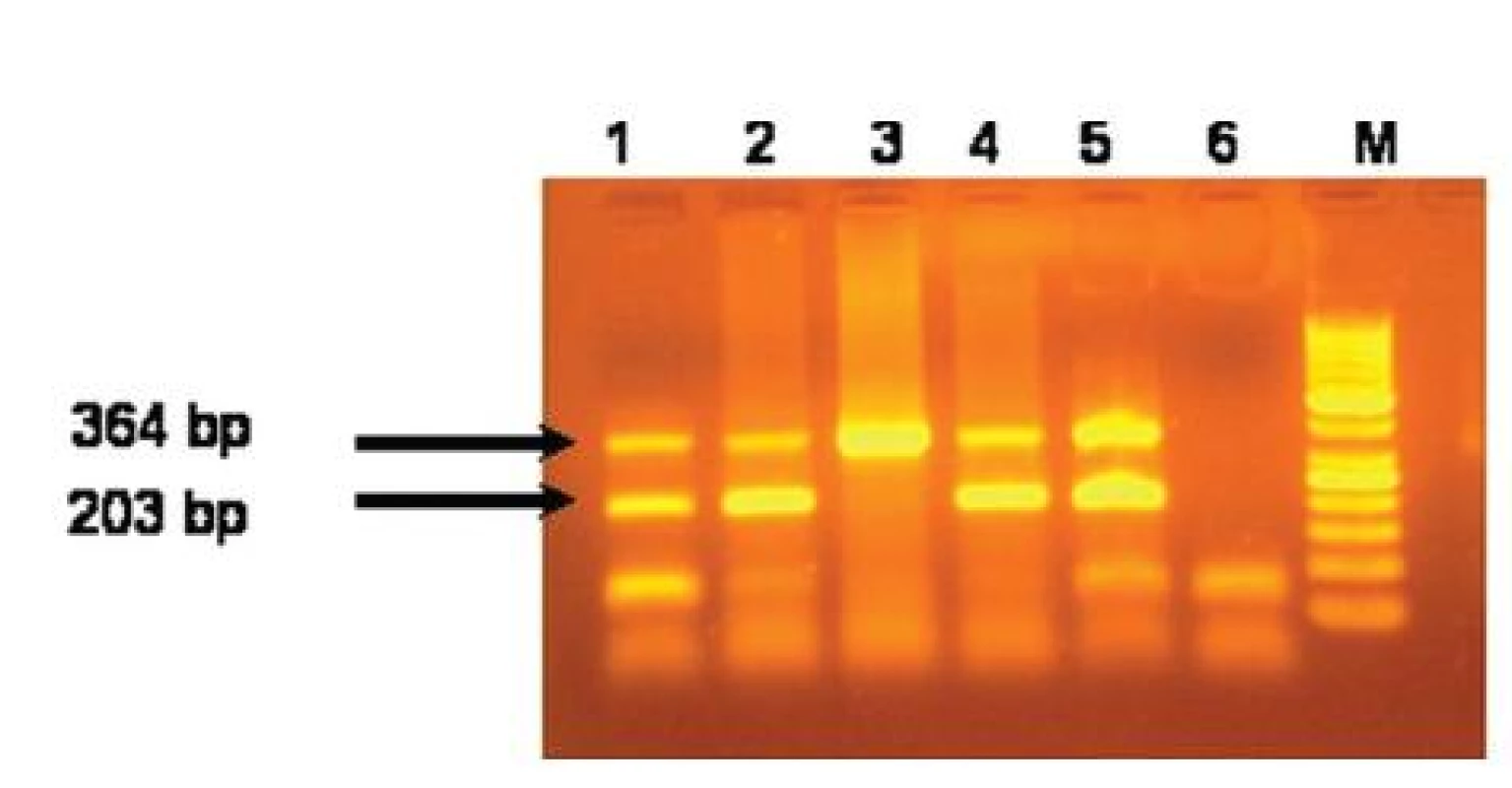 Výsledky alelovo-špecifickej hot start multiplex PCR na detekciu JAK2 V617F mutácie. Dráhy 1,2,4 a 5 predstavujú pacientov s JAK2V617F mutáciou. Dráha 3 je pacient bez JAK2V617F mutácie. Dráha 6 je negatívna kontrola a dráha M je 50 bp ladder.
