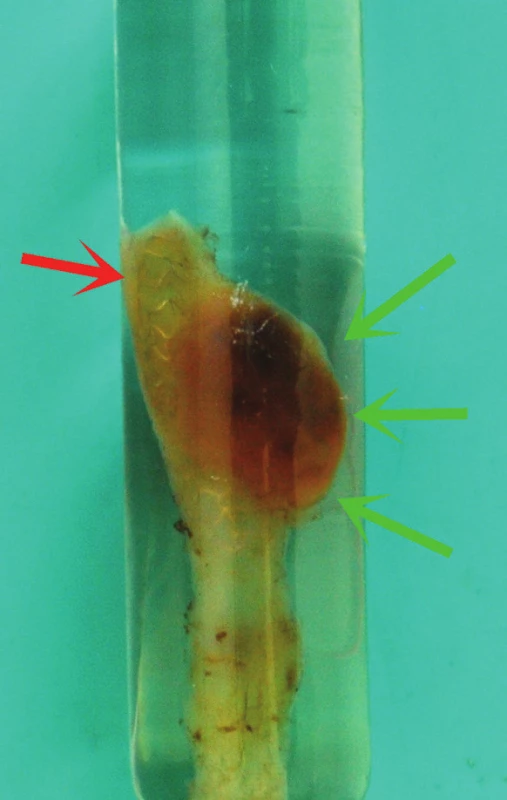 Resekát po zalití do polymetylmetakrylátové pryskyřice. V horní části je patrná výduť stěny štěpu (zelené šipky); červená šipka ukazuje strukturu MGuard stentu, který prosvítá stěnou resekátu.