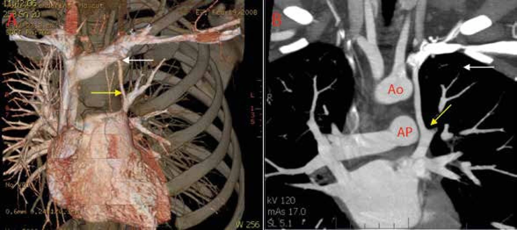 Výpočetní tomografie (CT) hrudníku