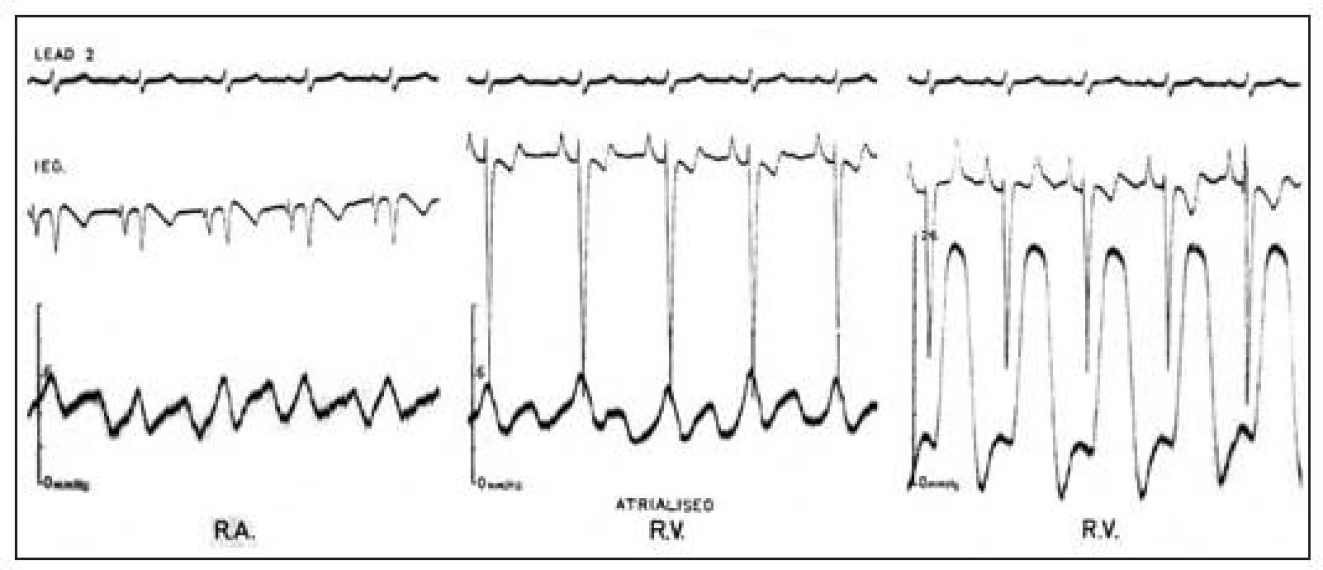 Záznamy u Ebsteinovy anomálie během srdeční katetrizace s elektrodou na katétru. V „atrializované“ části pravé komory se zaznamená současně se síňovým tlakovým pulzem komorový
intrakardiální elektrokardiogram (prostřední obrázek).