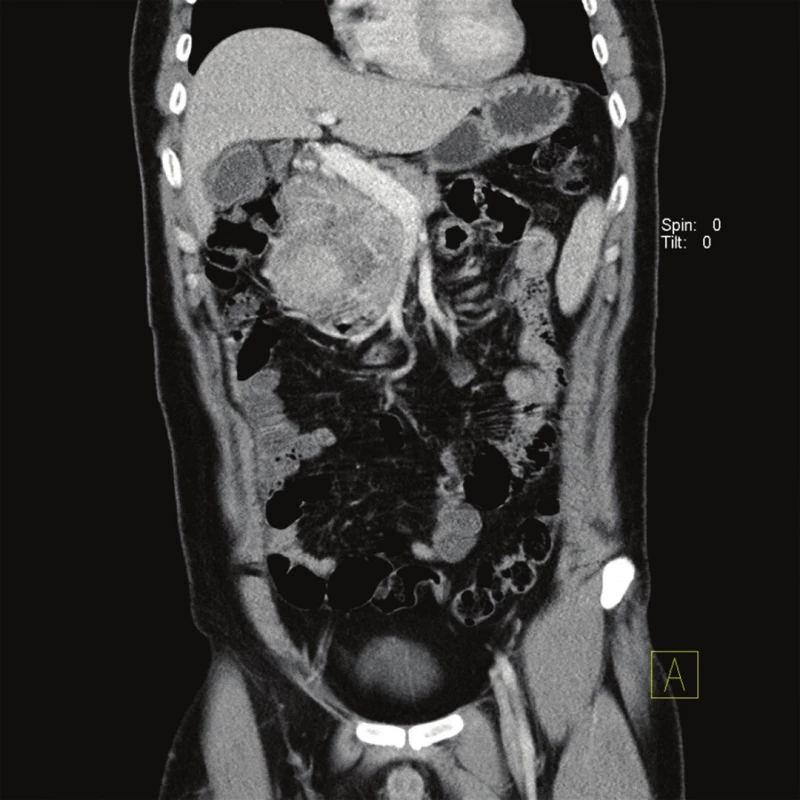 CT obraz útlaku hepatoduodenálního ligamenta tumorem retroperitonea – koronární řez
Fig. 2: CT image of compression hepaduodenal ligament caused by retroperitoneal tumor (coronal)