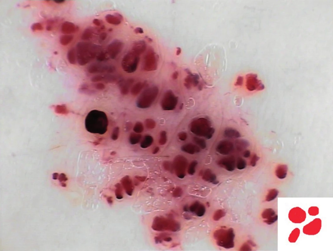 Cévní lakuny (hemangiom)