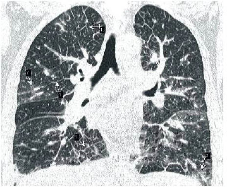 Churd-Strauss – četné septální linie č.1 a č. 2, mléčné sklo až kondenzace plicního parenchymu