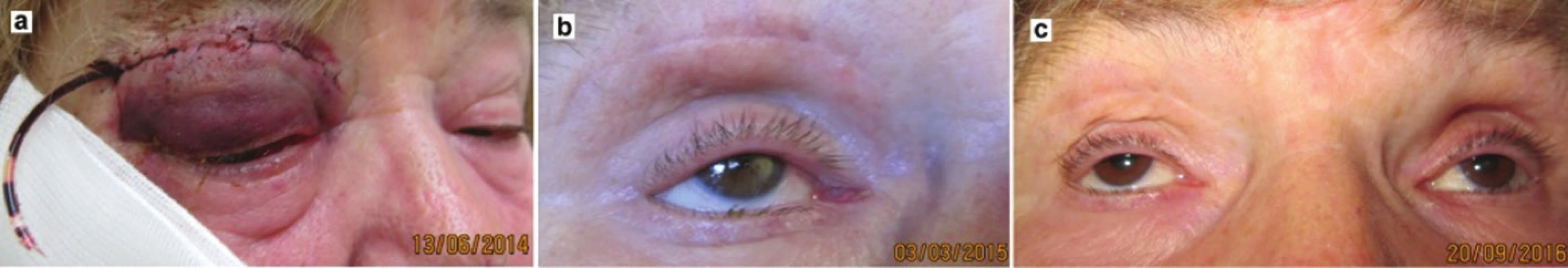Pacient po orbitotómii pre lymfóm pravej očnice: a) tretí deň po zákroku pred vybratím drenu – 2014, b) klinický nález o 9 mesiacov – 2015 , c) klinický nález pri kontrole – 2016