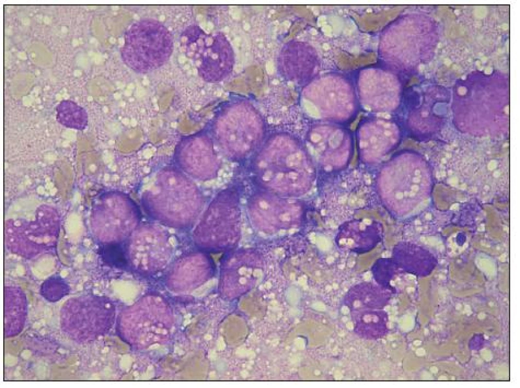 Velké ložisko RMS buněk v KD, prostoupené četnými vakuolami, které místy splývají a vytvářejí tak tzv. „jezírka“ (lakes). Místy je naznačena fagocytóza erytrocytů.
