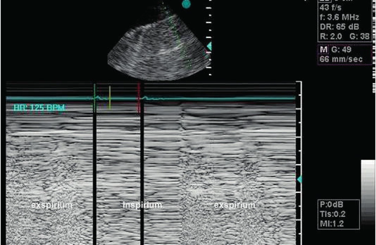 Pneumothorax
Lung point detekovaný transthorakální sondou v přední axilární čáře. M-mode v sektoru nahoře je proložen zónou pneumothoraxu v inspiriu. Normální obraz je v levé části sektoru, která se dostává pod paprsek M-mode v exspiriu.