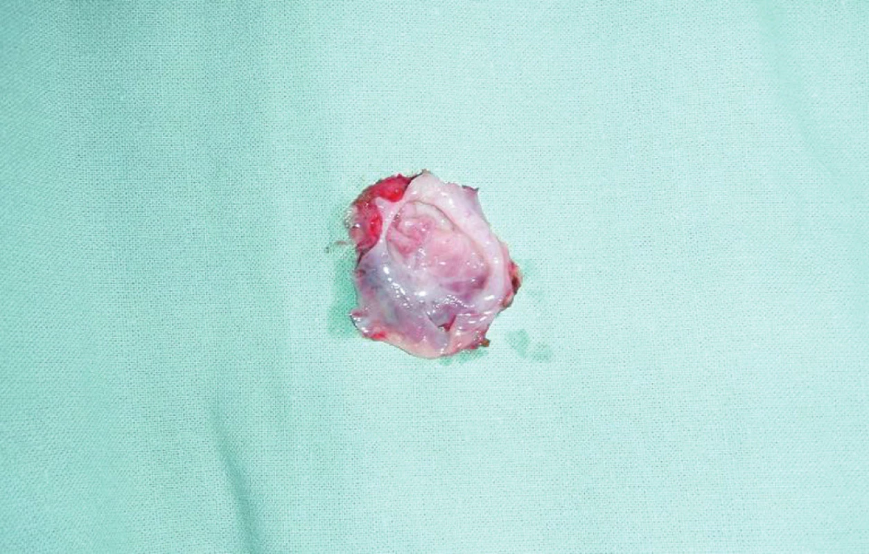 Rozstřižený preparát cysty
Fig. 5: The cyst preparation, cut open