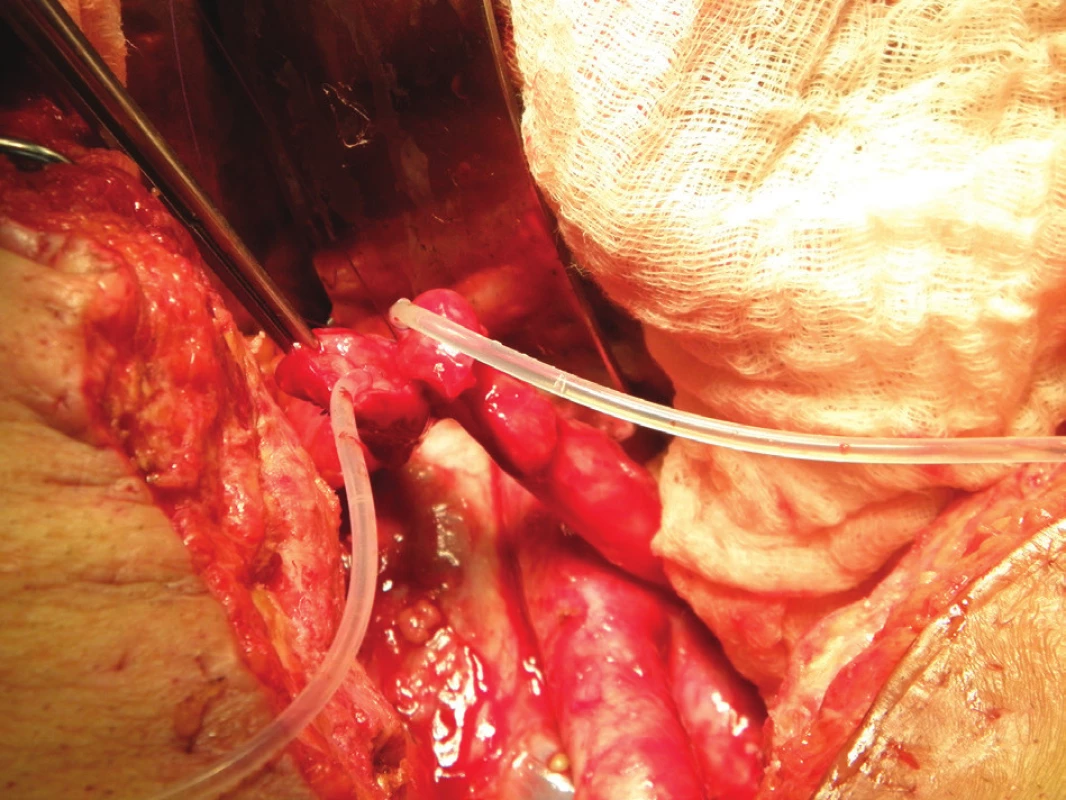 Operační nález: příprava společné lišty obou ureterů před uretero-ileo anastomózou – v obou ureterech jsou zavedeny splinty
Fig. 6: Intraoperative finding: common “batten“ of both ureters, prepared for uretero-ileal anastomosis – splints are visible in both ureters