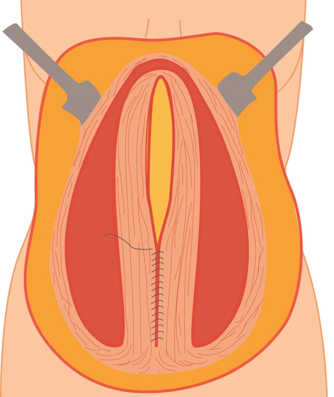 Sutura defektu břišní stěny (kýlní branky) pokračujícím stehem
Fig. 3: Suture of the abdominal wall using continuous suture