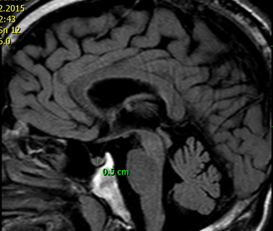 MRI 46letého muže s patogenní mutací genu AIP – otce dívky s gigantismem dokumentované na obr. 6. Tento muž má mikroadenom hypofýzy velikosti 5 mm, který je hormonálně němý.