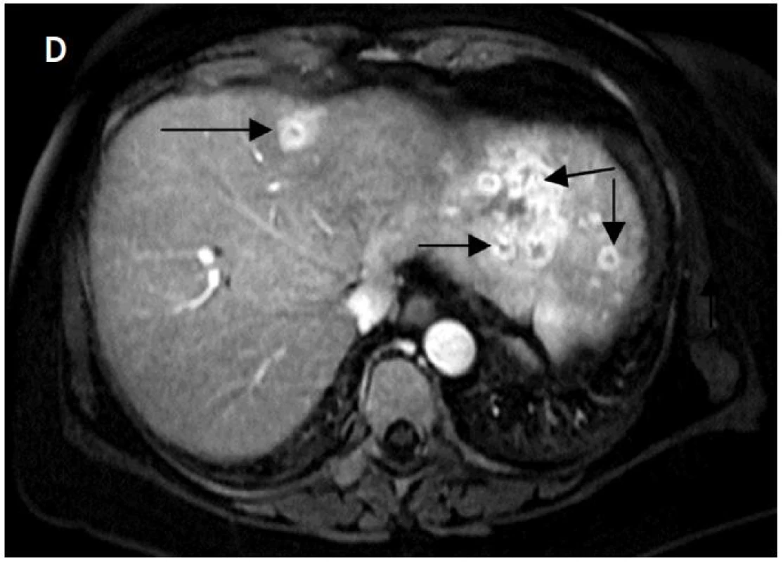 A – na axiálních CT skenech je patrná metastáza karcinomu štítné žlázy v levém jaterním laloku před IRE (šipka); B – uložení dvojice elektrod; C – rozsah nekrózy po IRE; D – výrazný enhacement v oblasti původního nádorového ložiska svědčí pro časnou postablační recidivu, další nová meta ložiska v obou jaterních lalocích (šipky)