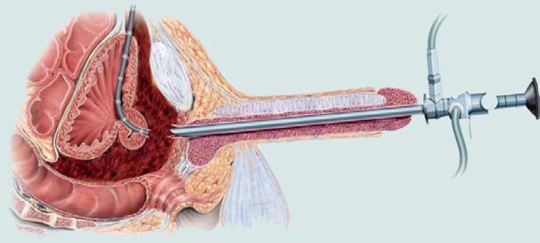 Poranění zadní části močové trubice. Obnovení kontinuity močové trubice pomocí endoskopického přístupu.