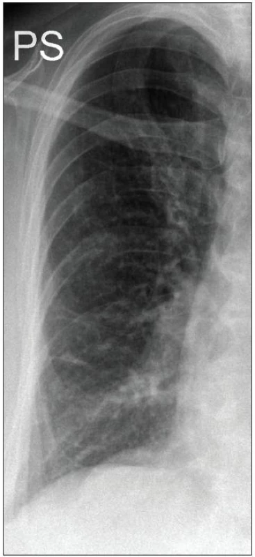 Digitální RTG snímek plic (09/2010). Vpravo laterálně lze již jen tušit reziduum po zaléčeném TBC ložisku indurace.